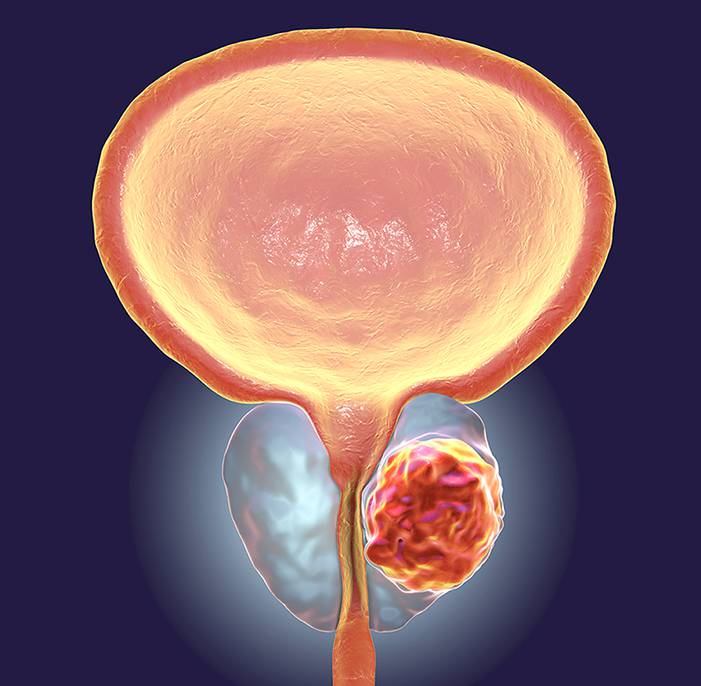 How to Test for Prostate Cancer